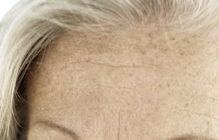 Testa com manchas senis visíveis numa pessoa de meia-idade