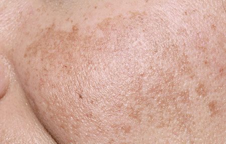 Close-up de bochechas femininas com melasma