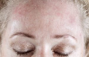 Woman´s forehead looking red and flaky