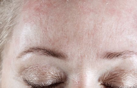 Mulher com testa descamando